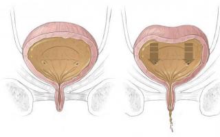 Гіперактивний сечовий міхур у жінок: лікування, причини, симптоми