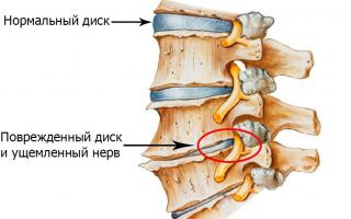 पीठ का ओस्टियोचोन्ड्रोसिस