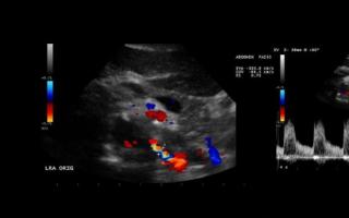 УЗИ почечных артерий – методика проведения исследования