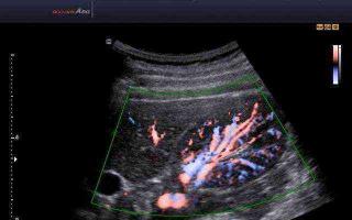 Ultrazvuk bubrega s dopplerografijom krvnih žila sigurna je i informativna metoda pregleda.