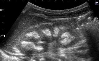 Ultrasound of the kidneys: the norm for children and adults and interpretation of the normal size of the kidneys of women ultrasound
